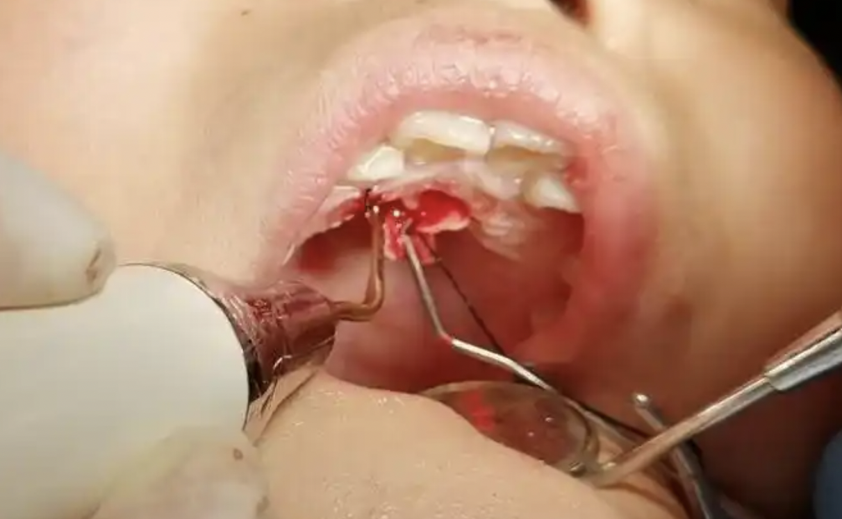 A must-read purchasing guide for dental dealers-Ultra bone surgery