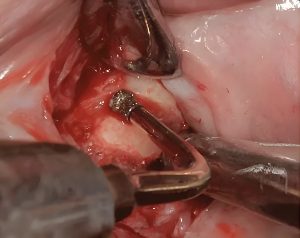 A must-read purchasing guide for dental dealers-Ultra bone surgery