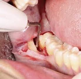 Advantages of ultrasonic piezo bone surgery in minimally invasive tooth extraction