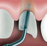 Advantages of ultrasonic piezo bone surgery in minimally invasive tooth extraction Advantages of ultrasonic piezo bone surgery in minimally invasive tooth extraction