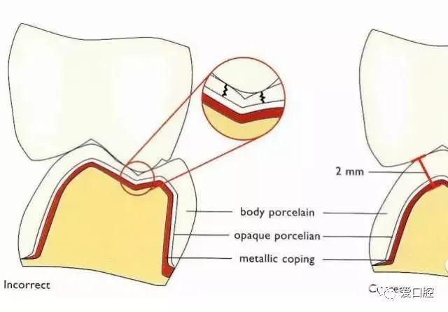 Some frequently overlooked issues in tooth preparation