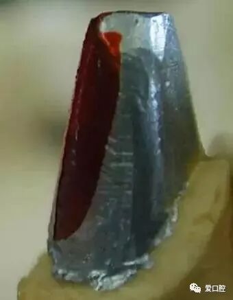 Some frequently overlooked issues in tooth preparation