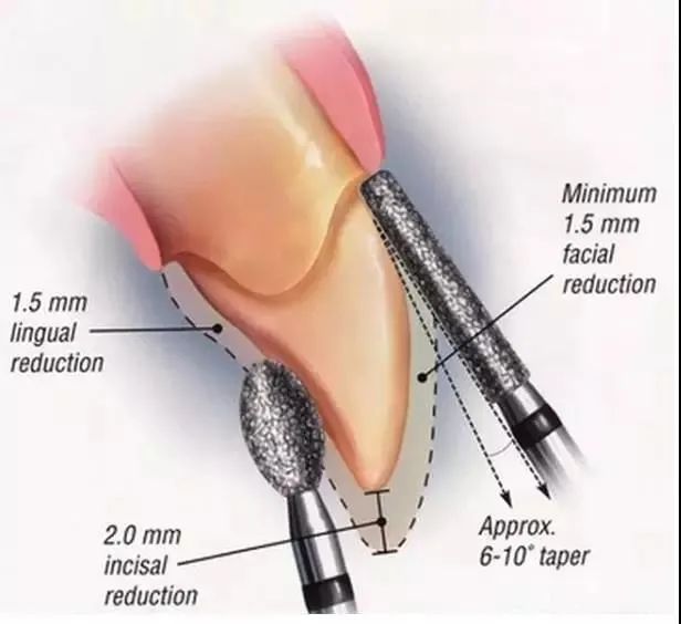 Some frequently overlooked issues in tooth preparation