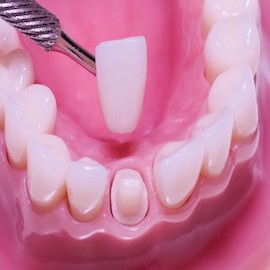 Some frequently overlooked issues in tooth preparation