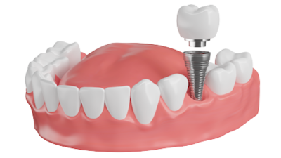 The Evolution of Dental Implant Instruments: From Traditional to Digital Guides