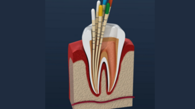 How to use apex locator to determine working length?