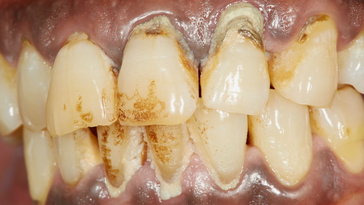 Is cleaning teeth good or bad? Is cleaning teeth good or bad?
