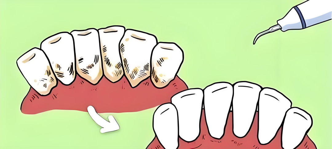 What is dental scaler and air polisher?