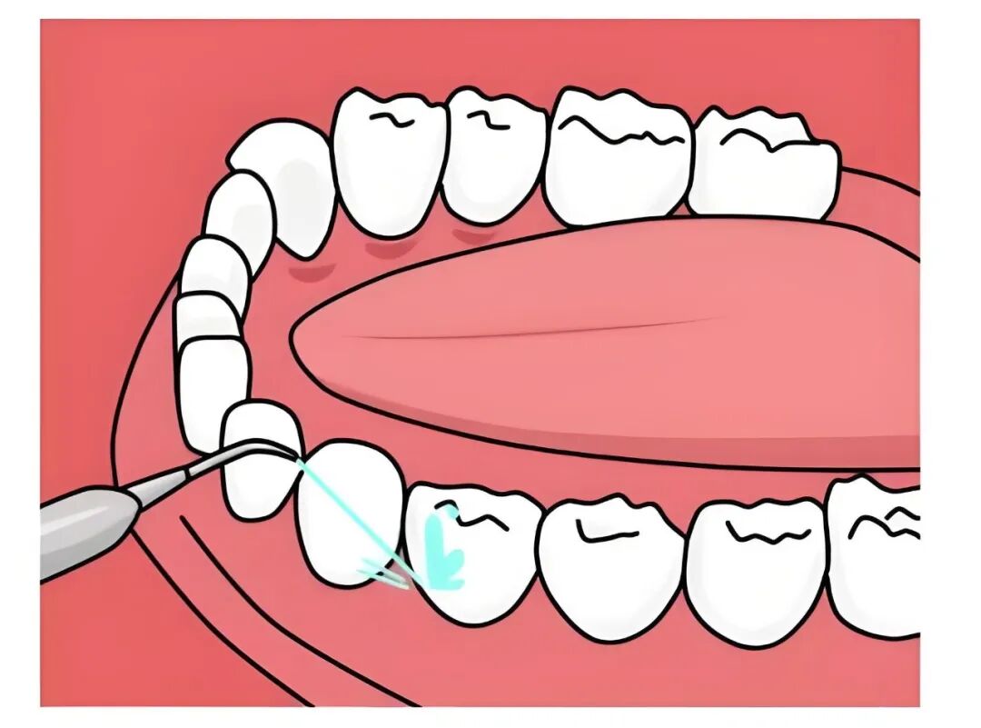 What is dental scaler and air polisher?