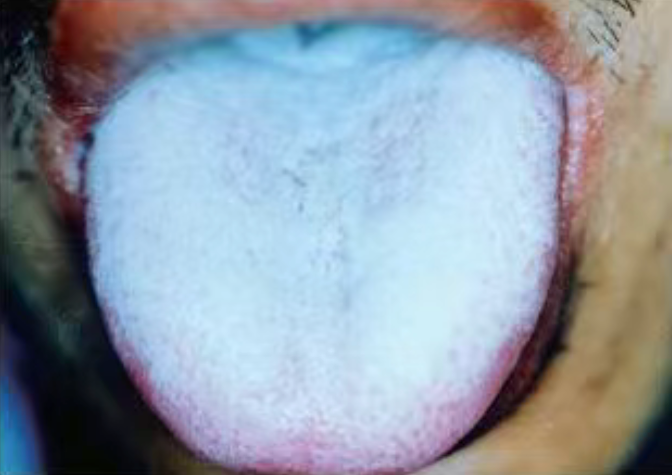 How Dentists Protect Themsevles From HIV/A Patient？