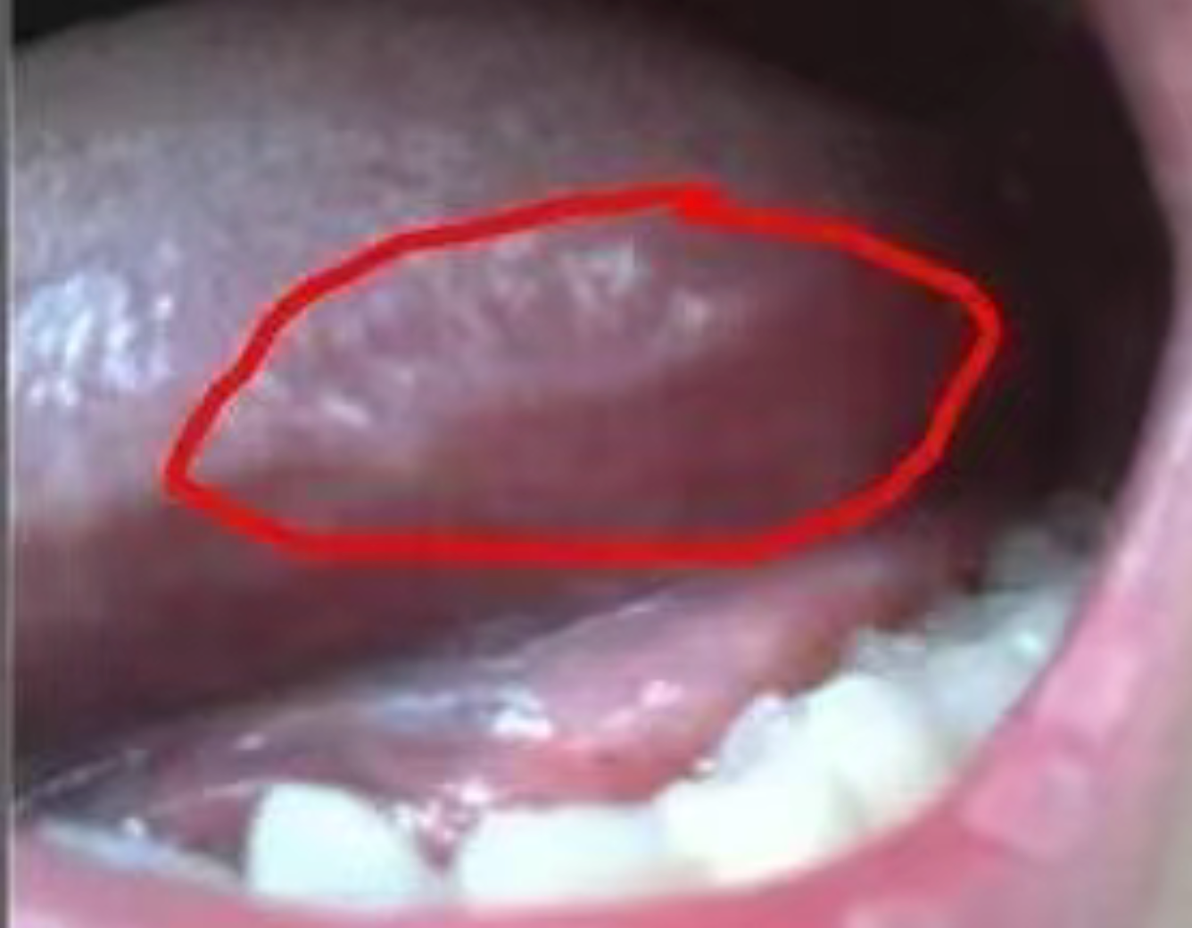 How Dentists Protect Themsevles From HIV/A Patient？