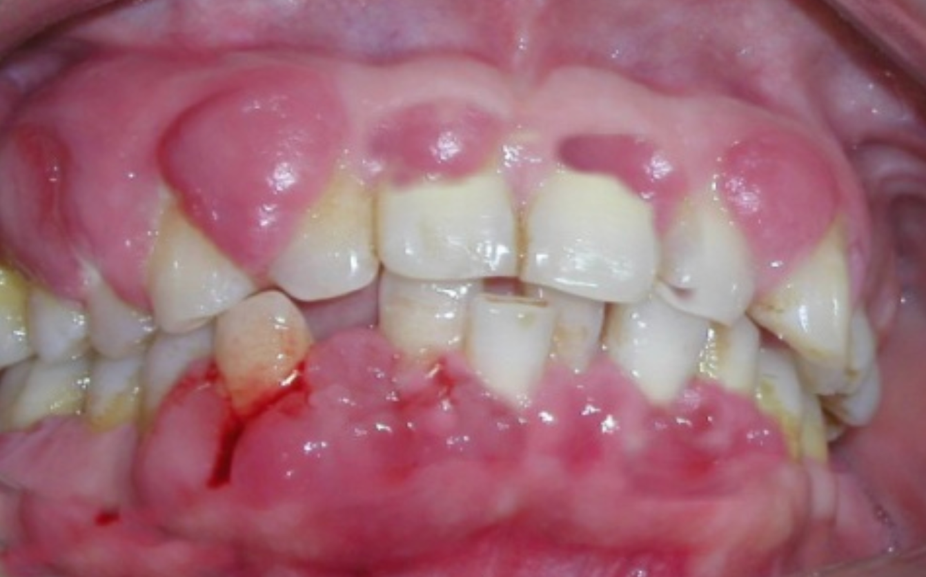 How Dentists Protect Themsevles From HIV/A Patient？