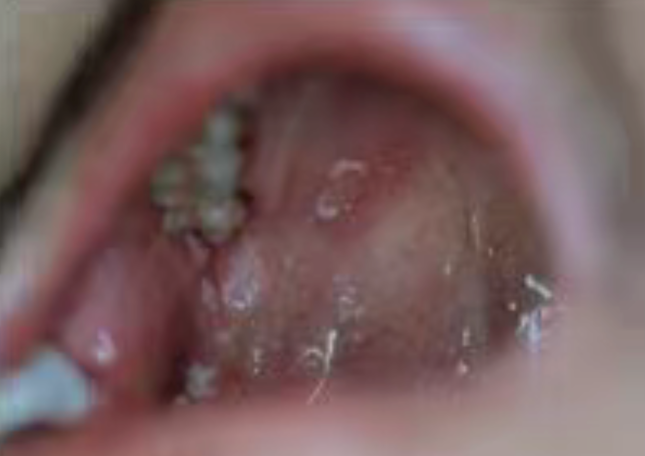 How Dentists Protect Themsevles From HIV/A Patient？