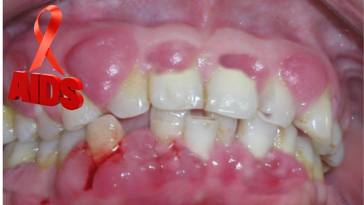 How Dentists Protect Themsevles From HIV/A Patient？