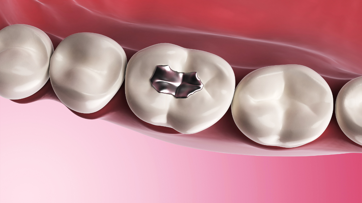 Why does a tooth still fall out after a filling? Why does a tooth still fall out after a filling?