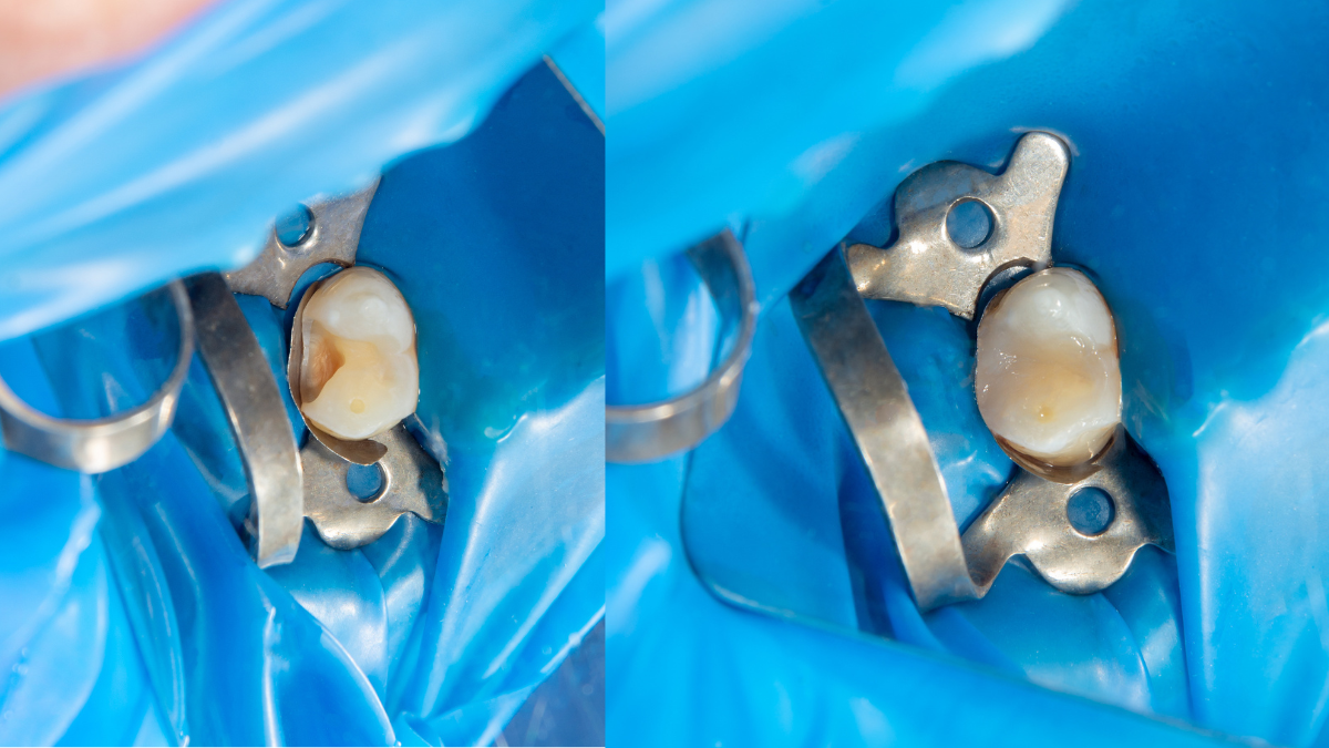 Why does a tooth still fall out after a filling?