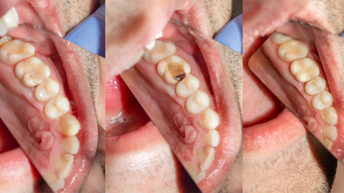 Why does a tooth still fall out after a filling? Why does a tooth still fall out after a filling?