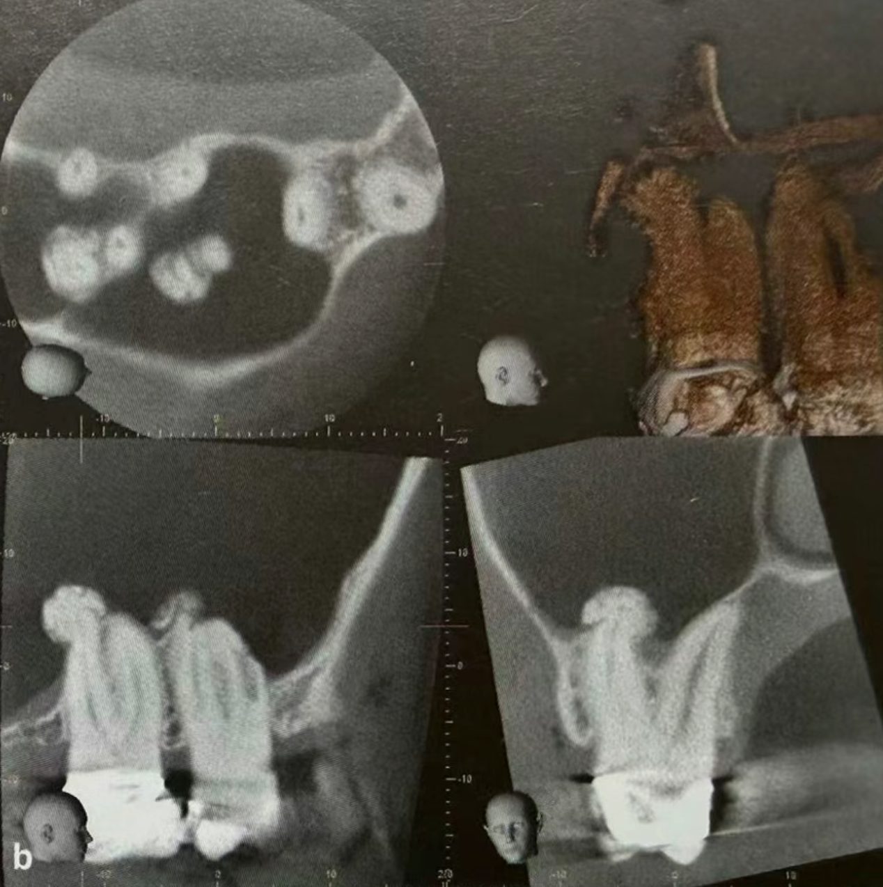 Common Dental Anomalies in Oral Imaging