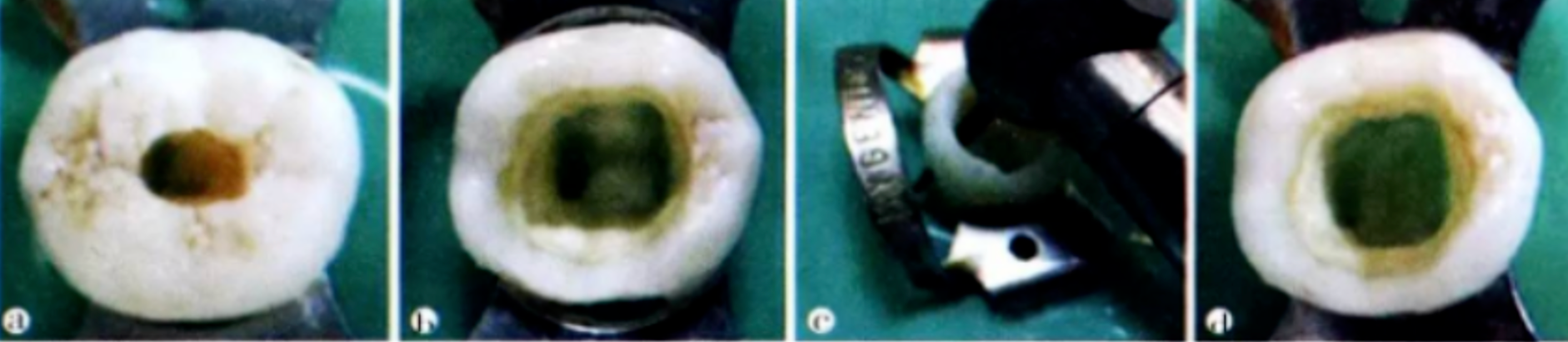 Common Procedural Errors in Root Canal Therapy: Improper Access Cavity Preparation