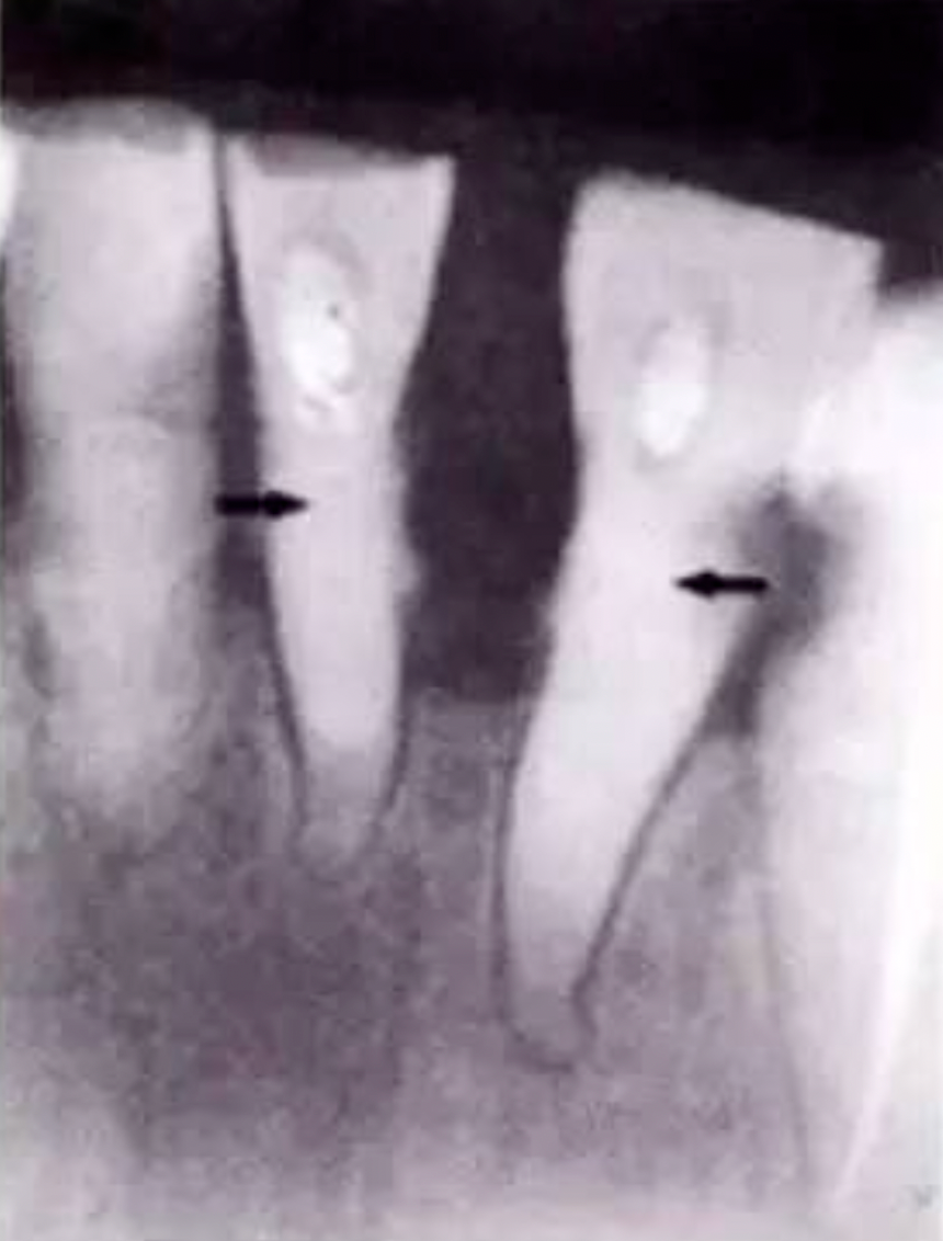 Common Procedural Errors in Root Canal Therapy: Improper Access Cavity Preparation Common Procedural Errors in Root Canal Therapy: Improper Access Cavity Preparation