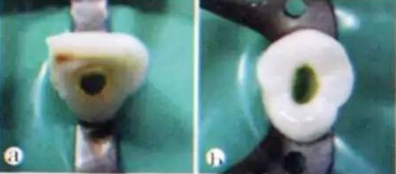 Common Procedural Errors in Root Canal Therapy: Improper Access Cavity Preparation