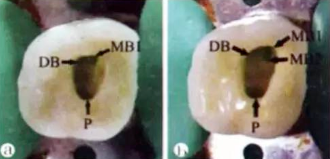 Common Procedural Errors in Root Canal Therapy: Improper Access Cavity Preparation