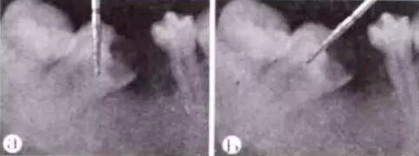 Common Procedural Errors in Root Canal Therapy: Improper Access Cavity Preparation
