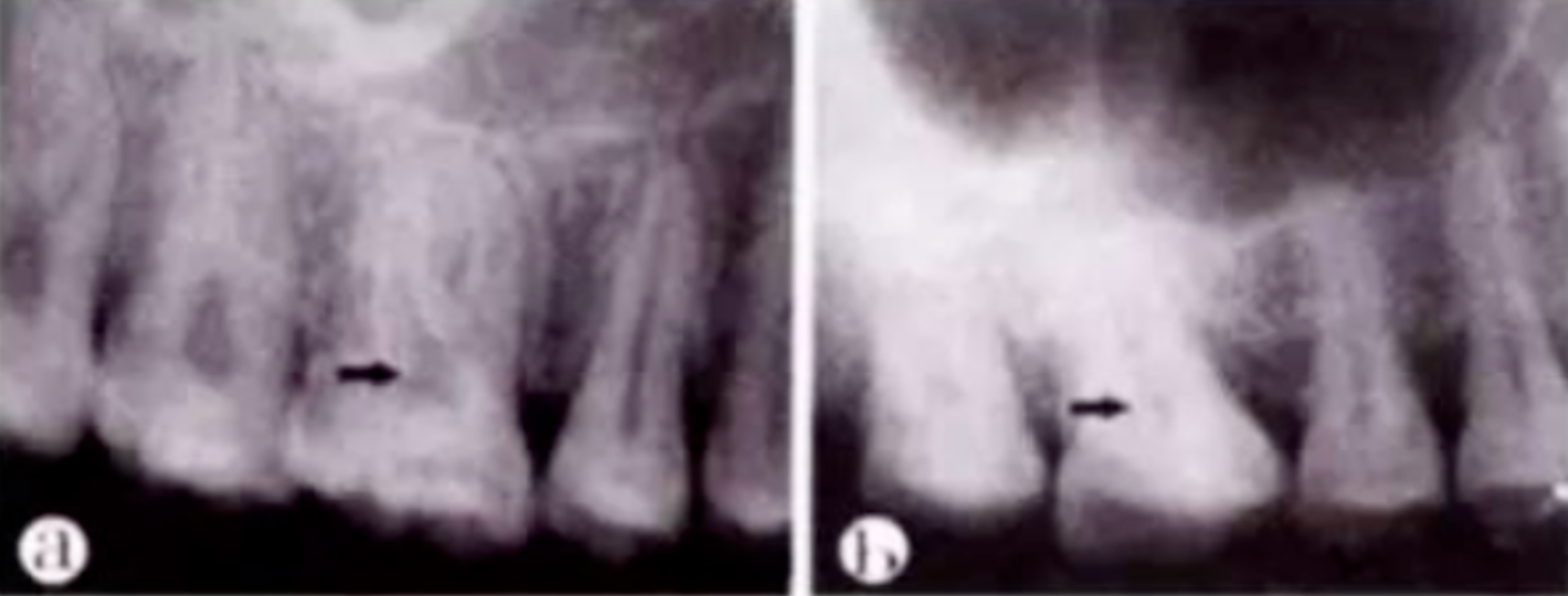 Common Procedural Errors in Root Canal Therapy: Improper Access Cavity Preparation