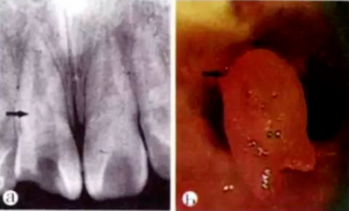 Common Procedural Errors in Root Canal Therapy: Improper Access Cavity Preparation