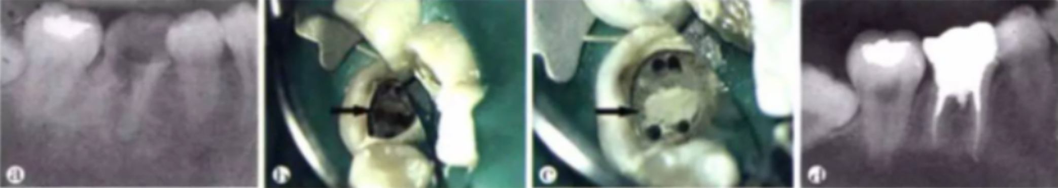 Common Procedural Errors in Root Canal Therapy: Improper Access Cavity Preparation