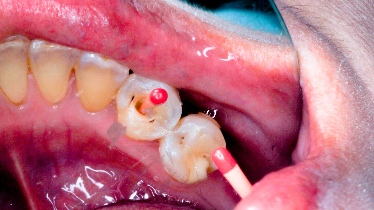 Common Procedural Errors in Root Canal Therapy: Improper Access Cavity Preparation Common Procedural Errors in Root Canal Therapy: Improper Access Cavity Preparation