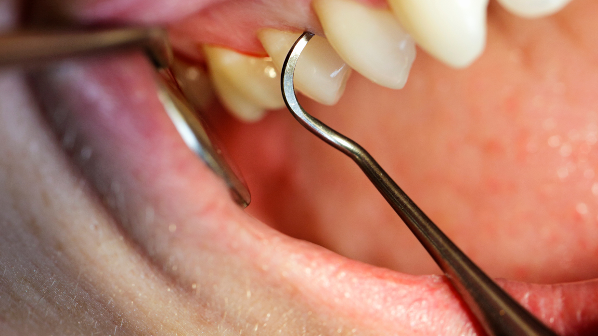  Is teeth cleaning by ultrasonic scaler harmful?