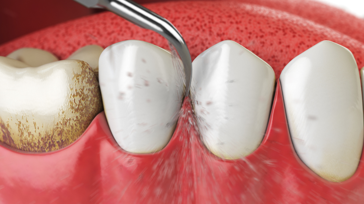  Is teeth cleaning by ultrasonic scaler harmful?