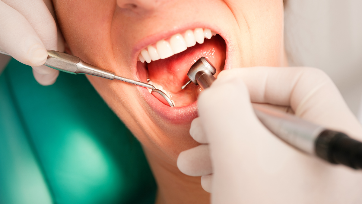  Is teeth cleaning by ultrasonic scaler harmful?