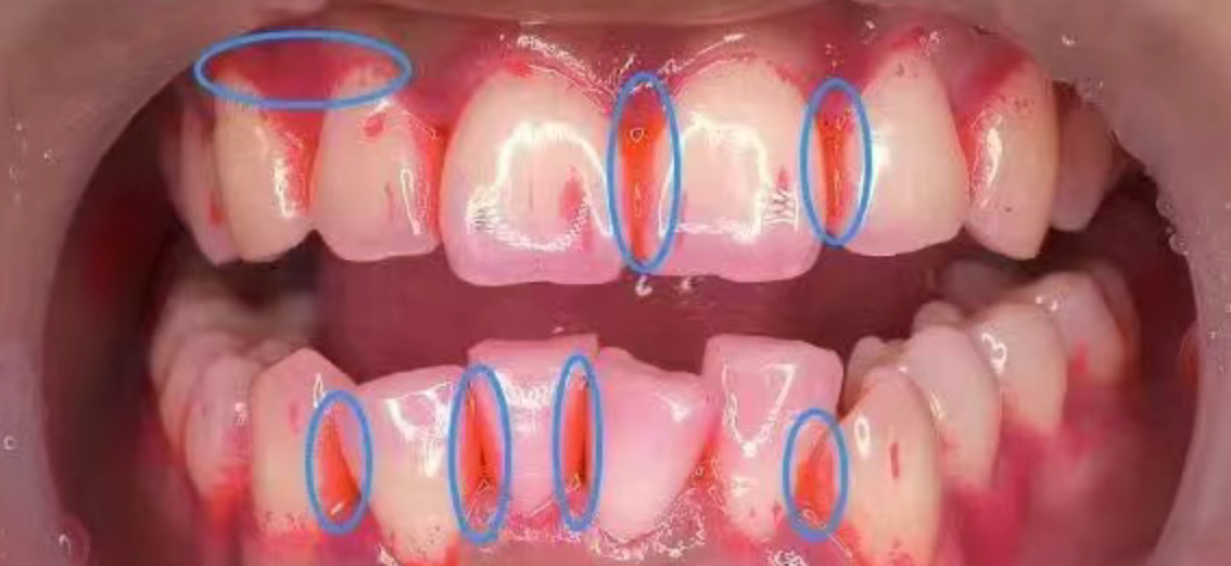 How did perfectly good teeth decay?