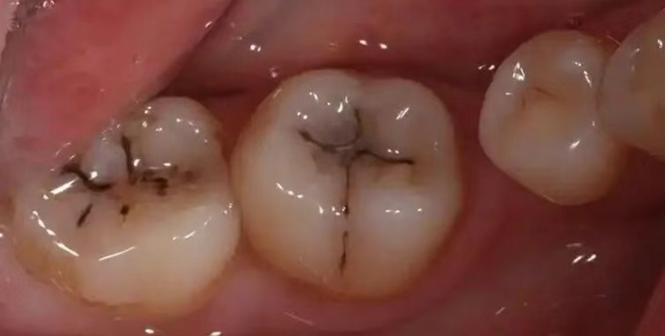 How did perfectly good teeth decay?