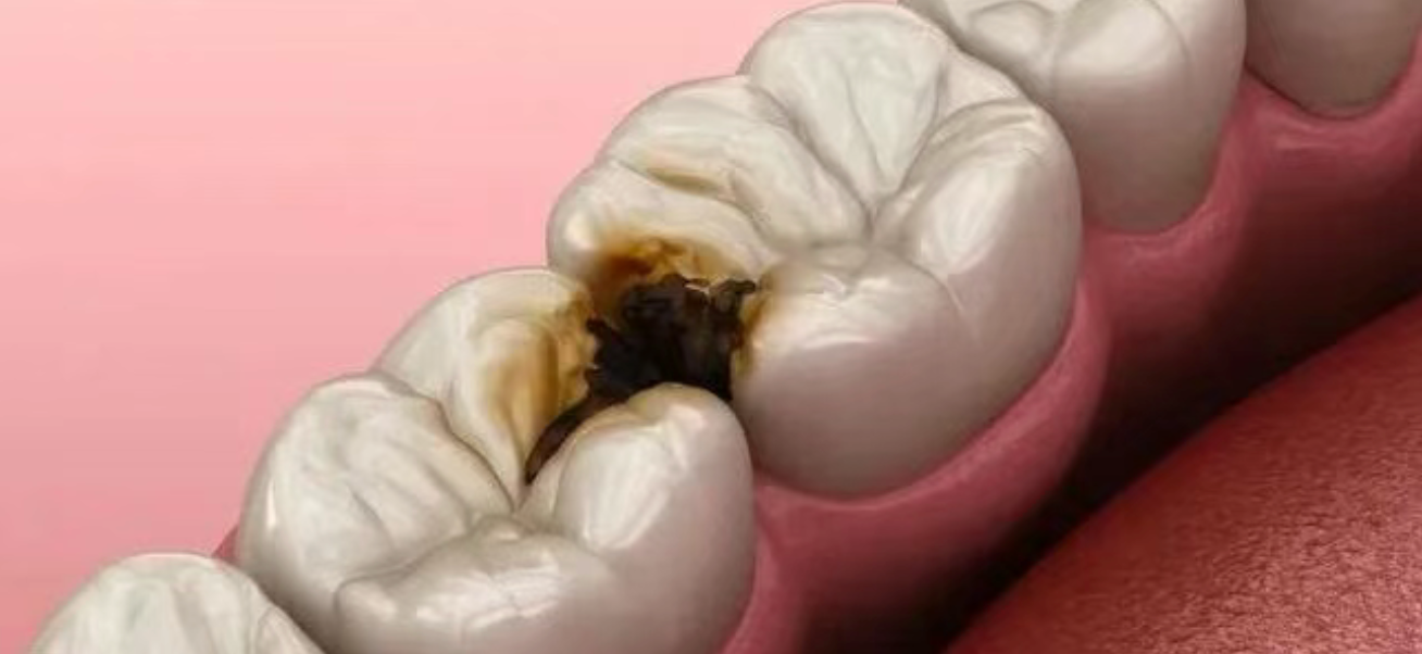 How did perfectly good teeth decay?