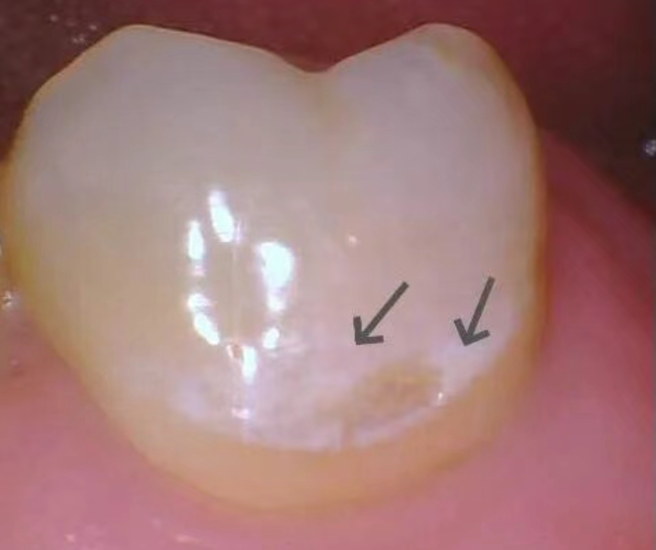 How did perfectly good teeth decay?