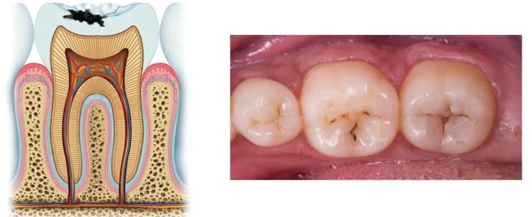 How did perfectly good teeth decay?