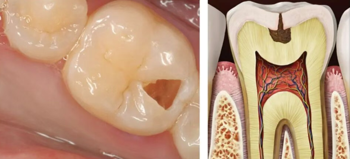 How did perfectly good teeth decay?