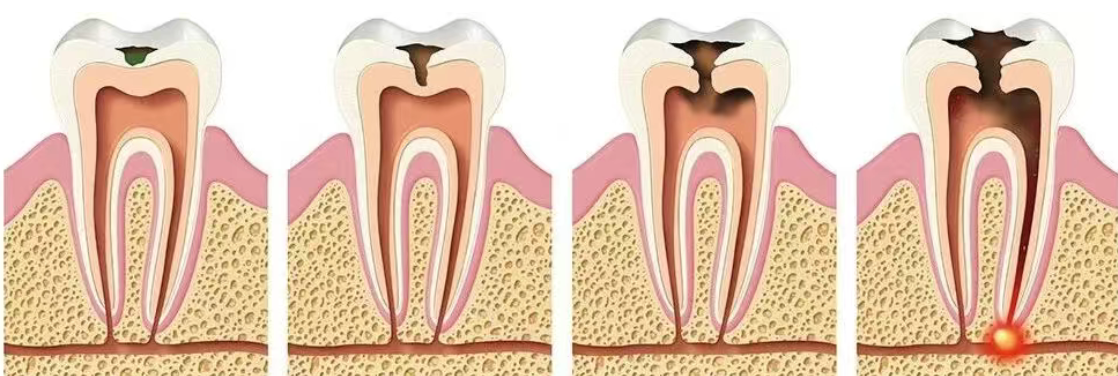 How did perfectly good teeth decay?