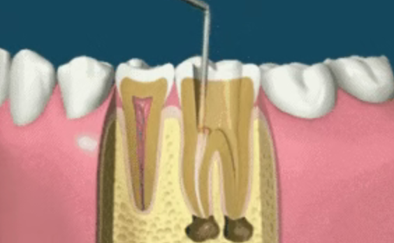Why isn't root canal treatment completed in one session? Why isn't root canal treatment completed in one session?