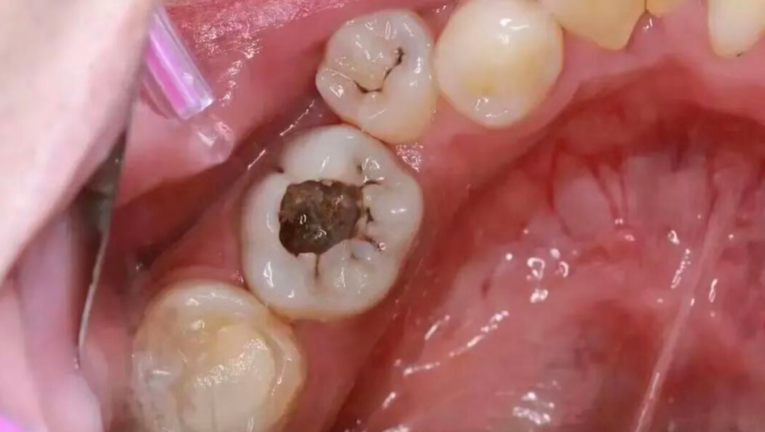 Why isn't root canal treatment completed in one session? Why isn't root canal treatment completed in one session?