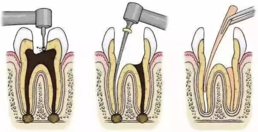 Why isn't root canal treatment completed in one session? Why isn't root canal treatment completed in one session?