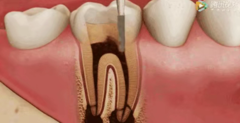 Why isn't root canal treatment completed in one session? Why isn't root canal treatment completed in one session?