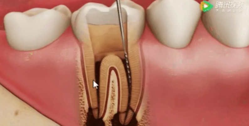 Why isn't root canal treatment completed in one session? Why isn't root canal treatment completed in one session?