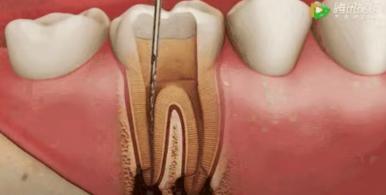Why isn't root canal treatment completed in one session? Why isn't root canal treatment completed in one session?