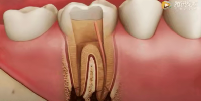 Why isn't root canal treatment completed in one session? Why isn't root canal treatment completed in one session?