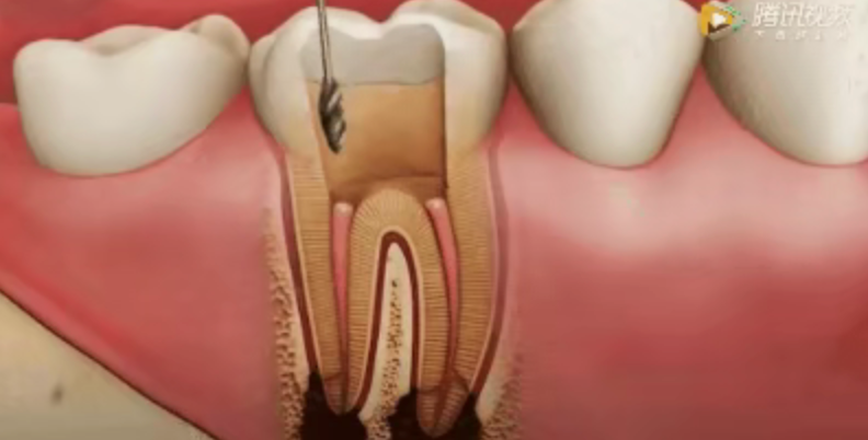 Why isn't root canal treatment completed in one session? Why isn't root canal treatment completed in one session?