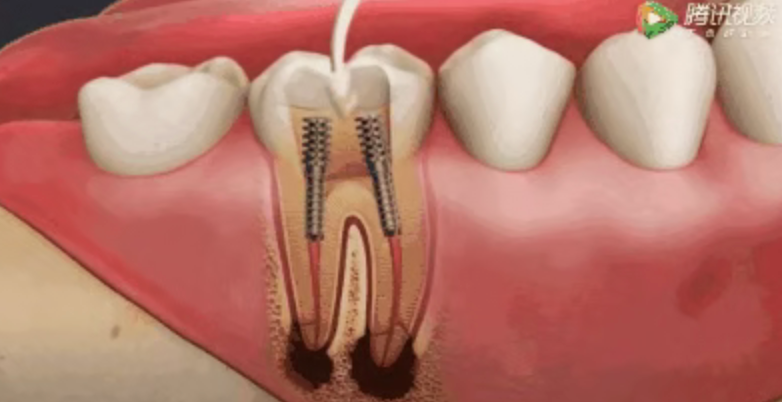 Why isn't root canal treatment completed in one session? Why isn't root canal treatment completed in one session?